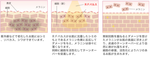 赤外線とRF高周波の光フォト